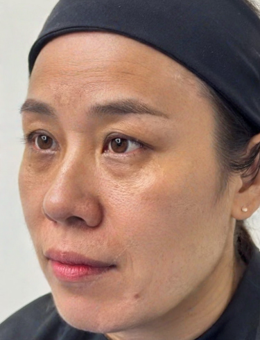 去眼袋手术