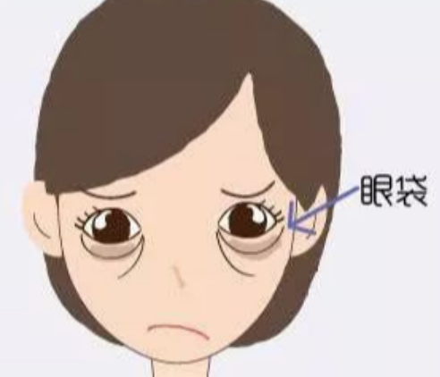 去眼袋手术