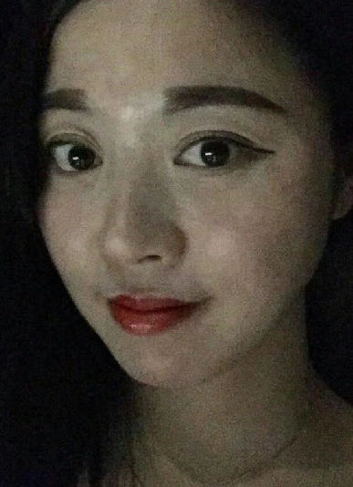 去眼袋手术