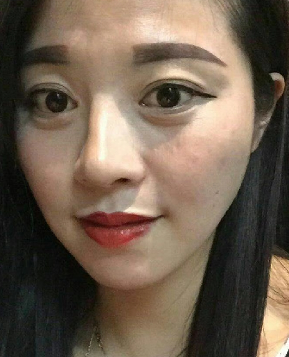 去眼袋手术