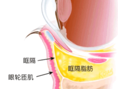 去眼袋手术