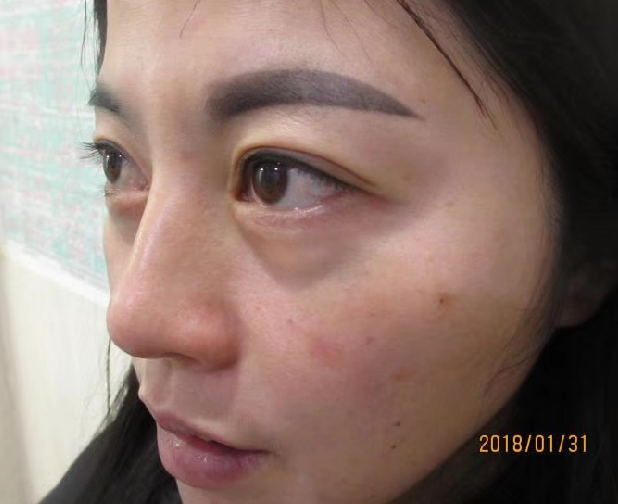 去眼袋手术