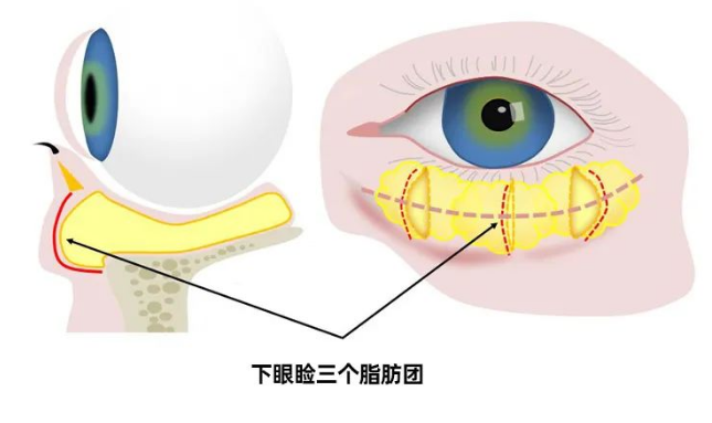 去眼袋手术