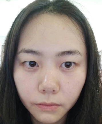 去眼袋手术