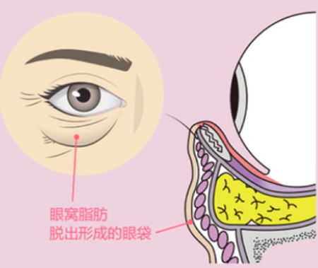 去眼袋手术