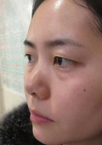 去眼袋手术