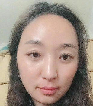 去眼袋手术