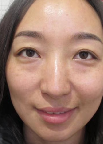 去眼袋手术