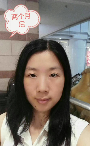 去眼袋手术