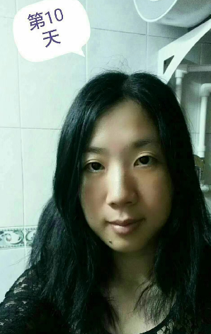 去眼袋手术