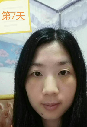 去眼袋手术