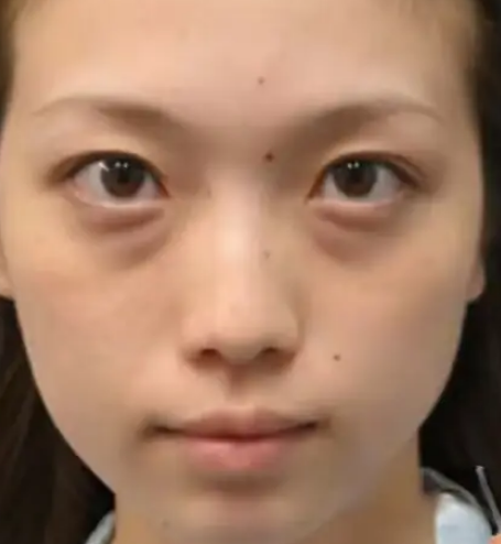 去眼袋手术