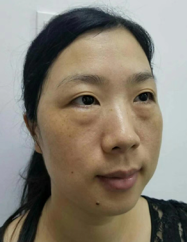 去眼袋手术