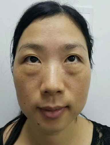 去眼袋手术