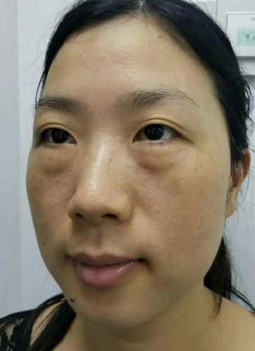 去眼袋手术