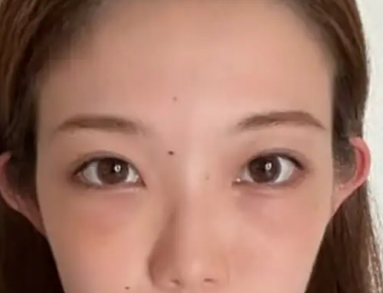 去眼袋手术