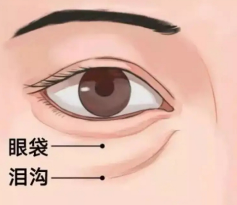 去眼袋手术