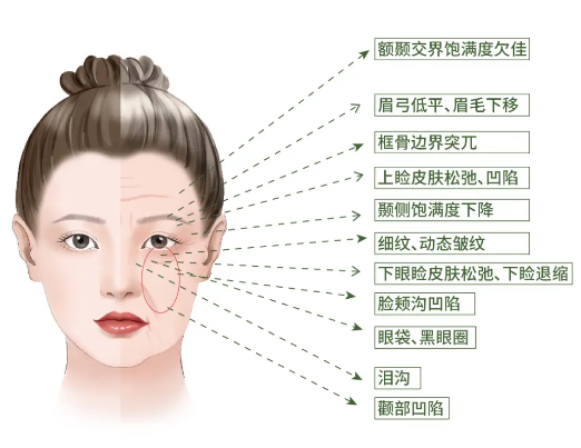眼袋