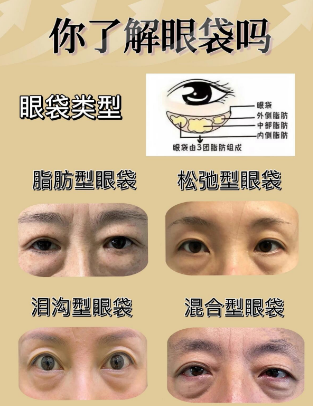 眼袋