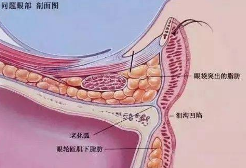 眼袋