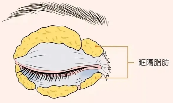 眼袋