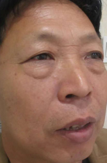 去眼袋手术