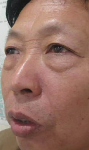 去眼袋手术