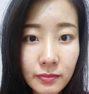 去眼袋手术