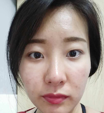去眼袋手术