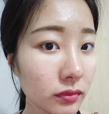 去眼袋手术