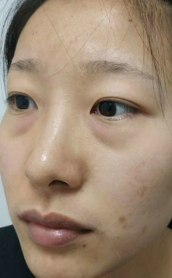 去眼袋手术