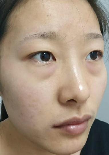 去眼袋手术