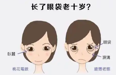 去眼袋手术