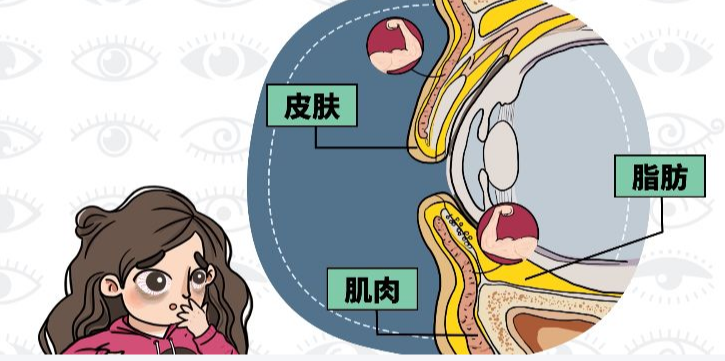 去眼袋手术