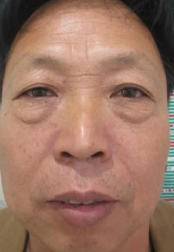 去眼袋手术