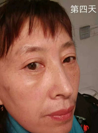 去眼袋手术