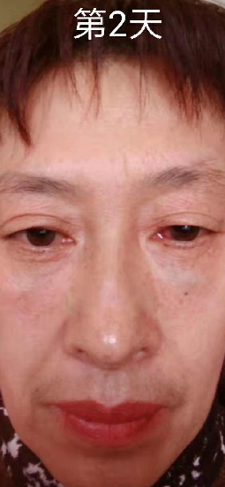 去眼袋手术