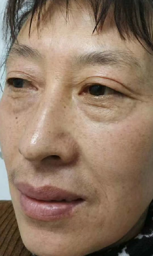 去眼袋手术