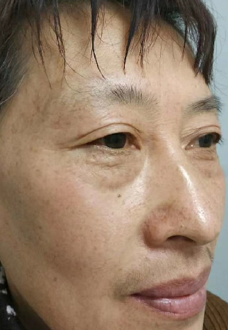 去眼袋手术