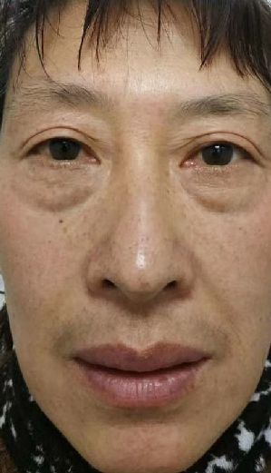 去眼袋手术