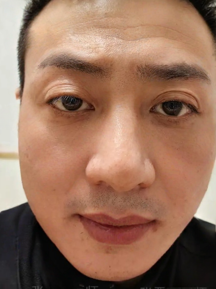 去眼袋手术