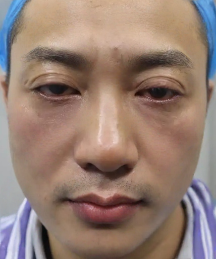 去眼袋手术