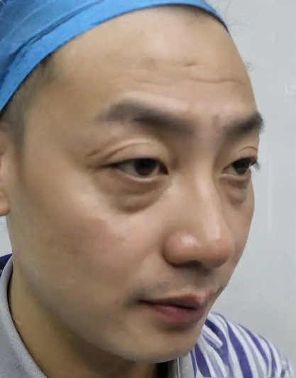 去眼袋手术