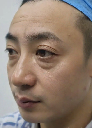 去眼袋手术