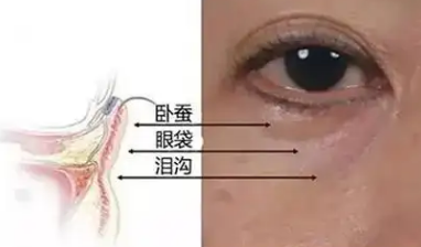 去眼袋手术