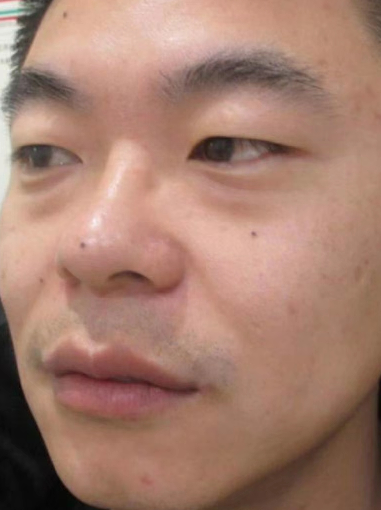 去眼袋手术