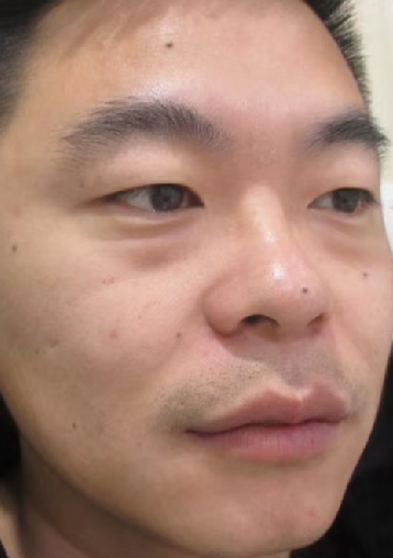 去眼袋手术