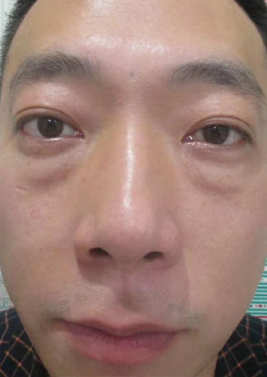 去眼袋手术