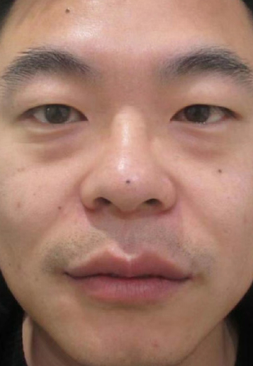 去眼袋手术