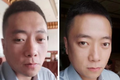 去眼袋手术